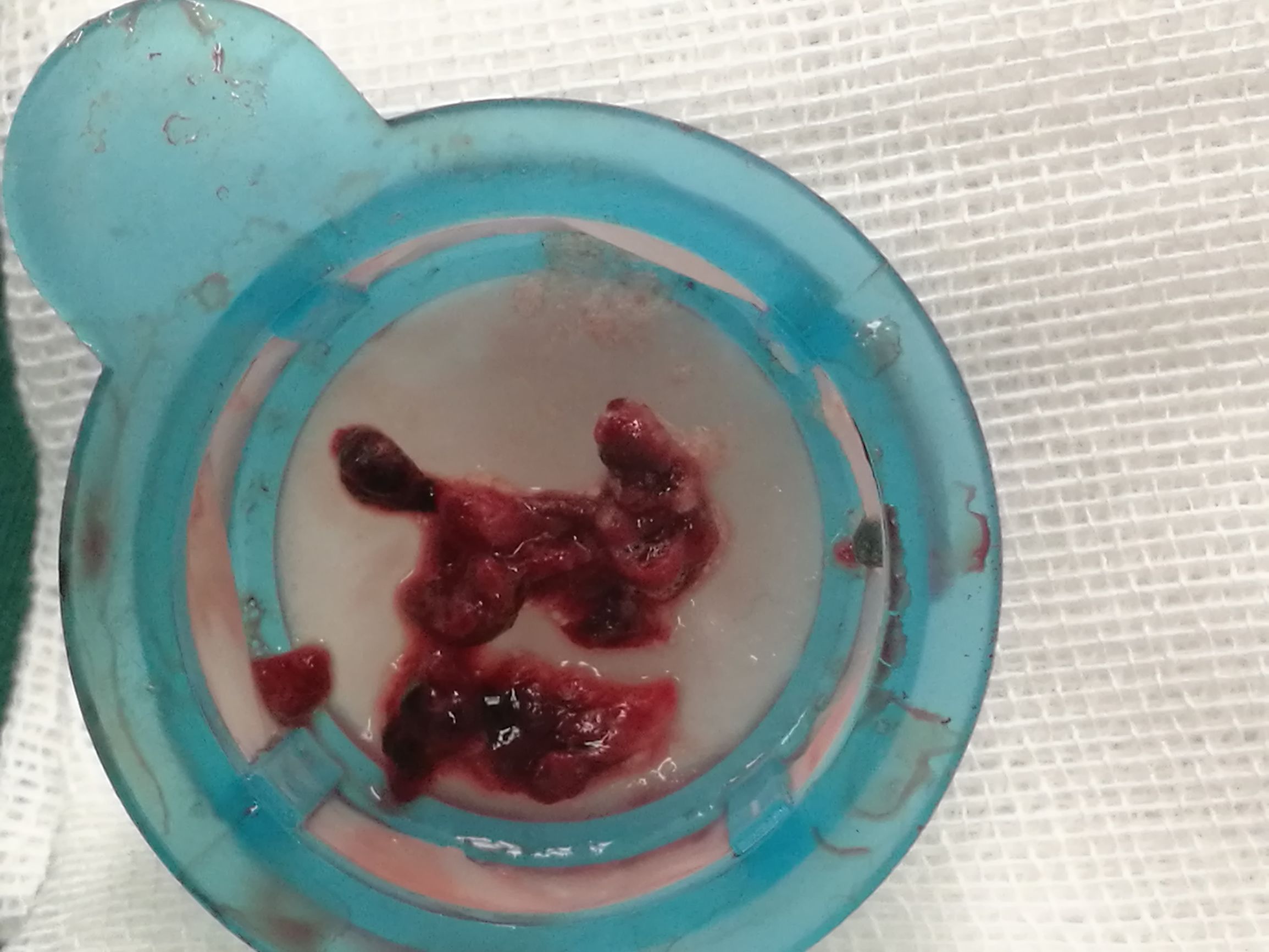 要命的肠缺血被轻松化解