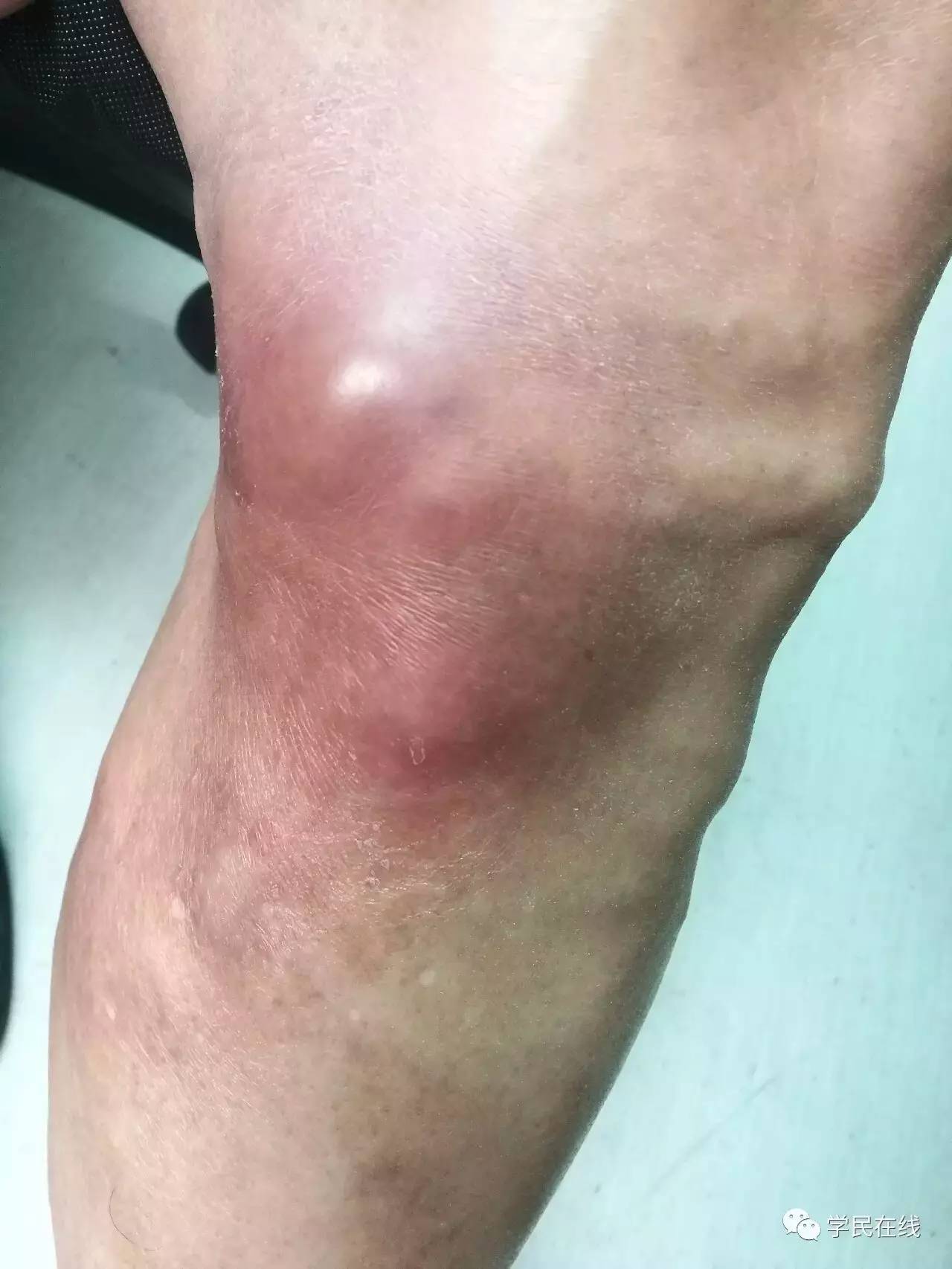 腿上长了这种包千万别瞎挤，谨慎猝死找上你！