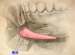 了解下丰胸的含义是什么,隆下巴科普