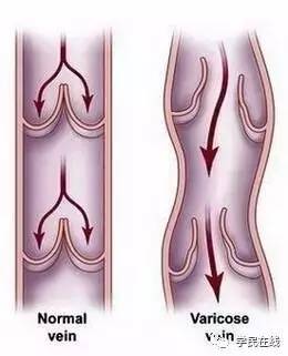腿上长了这种包千万别瞎挤，谨慎猝死找上你！