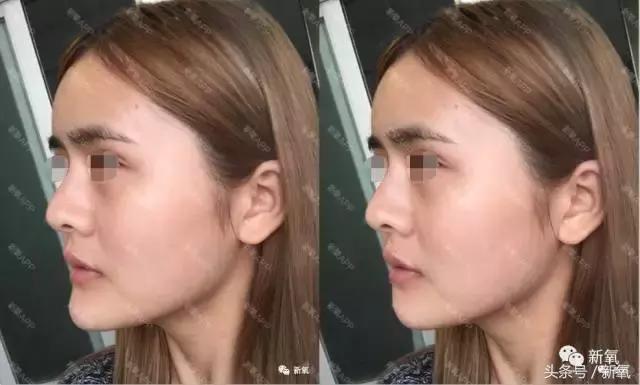 杨紫瘦了腿显得不纤细,杨紫变美之路脸怎么瘦的