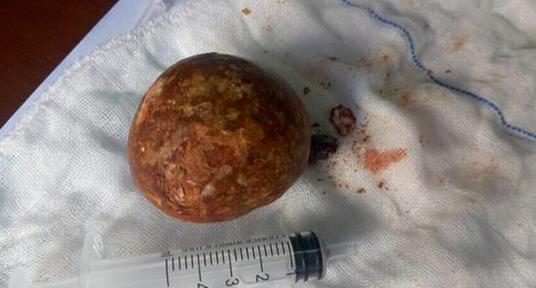 腰子含嘌呤多还是豆皮多,结石可以吃腰子吗