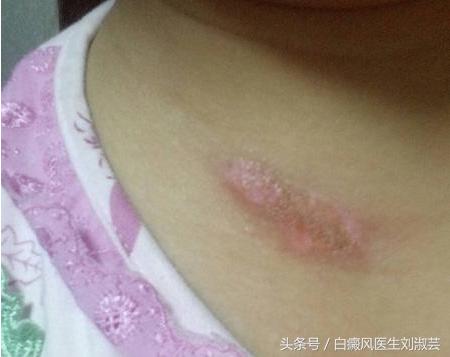 白癜风在治疗过程中白斑变红,身上长了白癜风怎么治疗