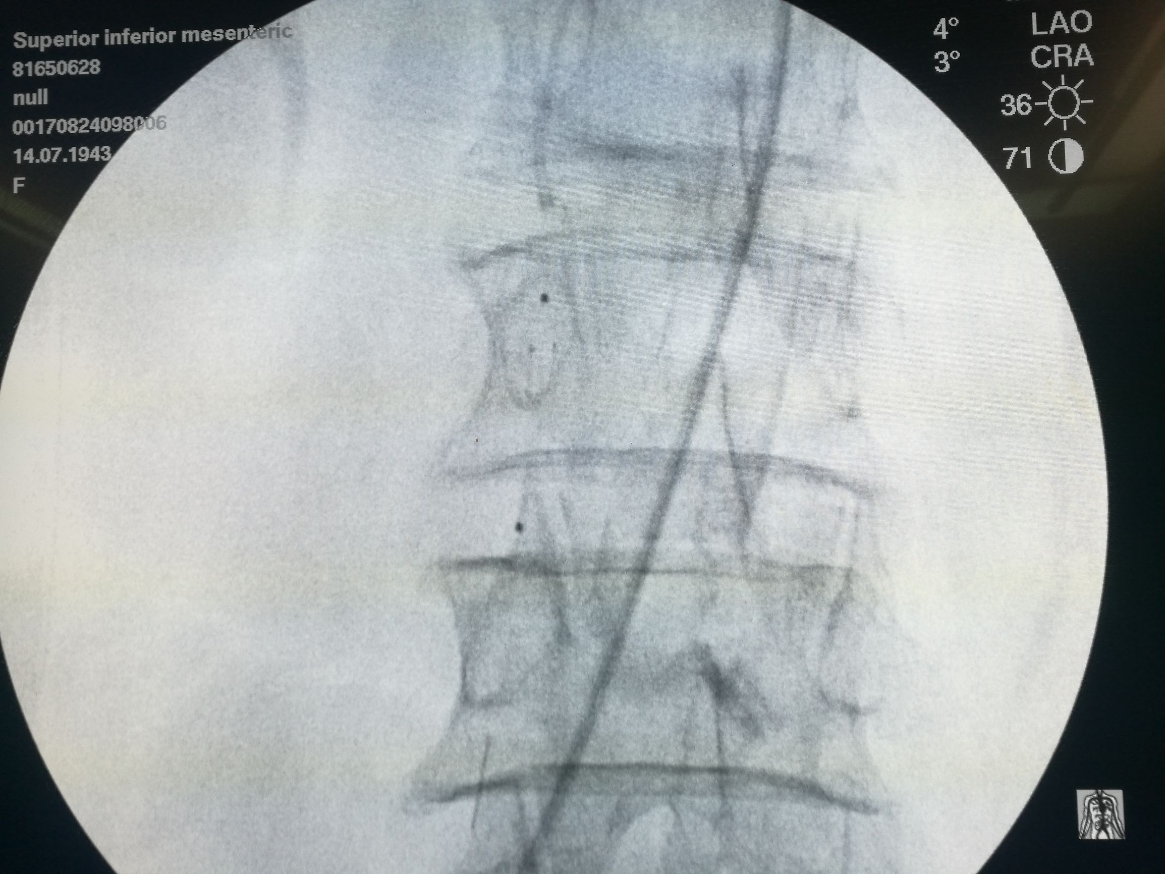 要命的肠缺血被轻松化解