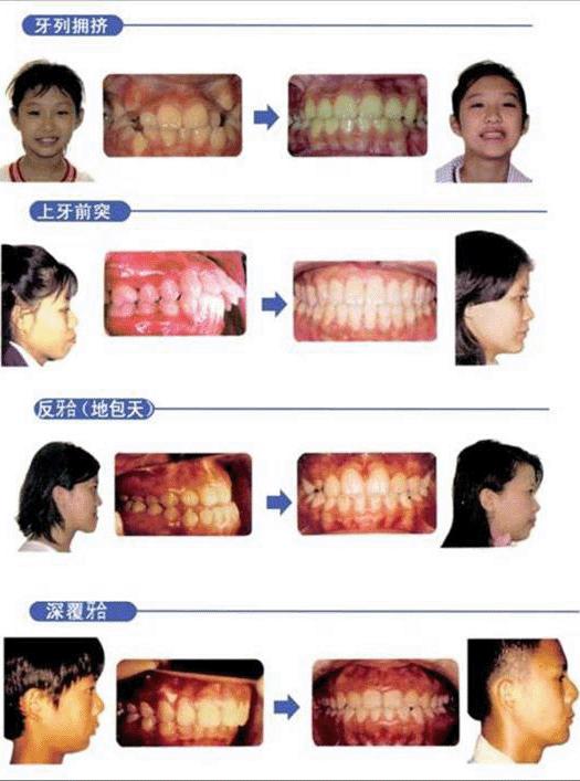 牙齿畸形不矫正的危害,牙齿畸形严重能矫正吗