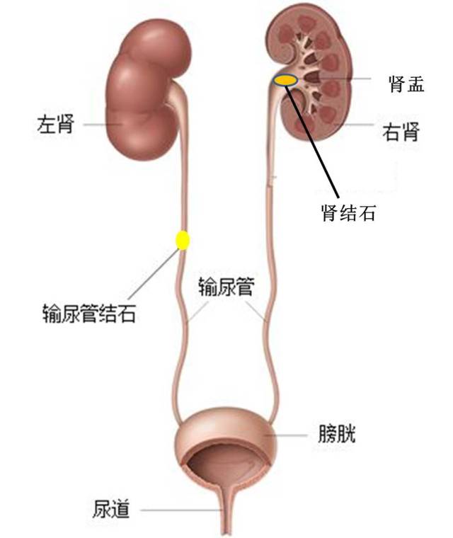 肾结石吃七种食物最好,用于治疗肾结石的药物