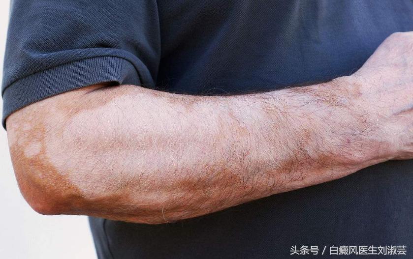 白癜风皮肤病有什么忌口,皮炎湿疹引起的白斑和白癜风区别