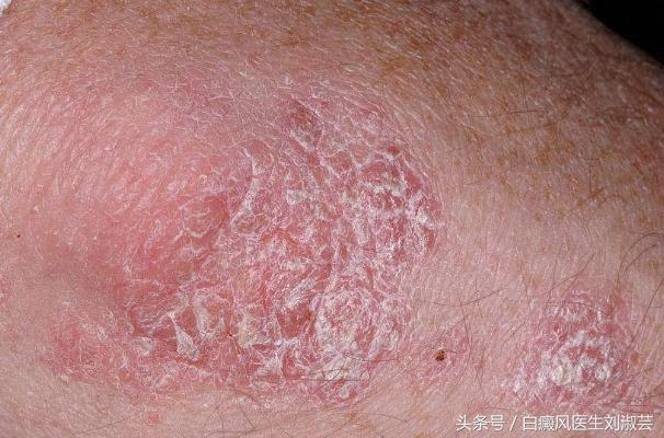 白癜风皮肤病有什么忌口,皮炎湿疹引起的白斑和白癜风区别