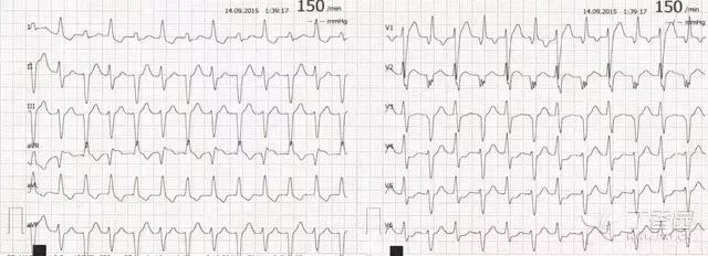 抗心律失常最好的中成药,兼有二三类抗心律失常效果的药物