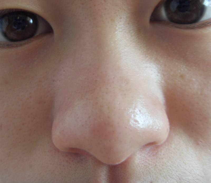 鼻子长黑头了4步骤安全去黑头,挤掉了黑头有洞