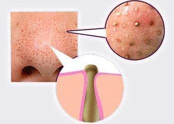 鼻子长黑头了4步骤安全去黑头,挤掉了黑头有洞