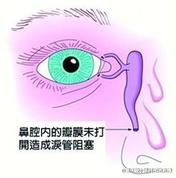 泪道阻塞什么方法可治10个月宝宝,宝宝泪道堵塞最好解决办法