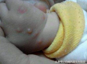 白癜风皮肤病有什么忌口,皮炎湿疹引起的白斑和白癜风区别