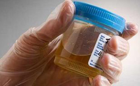 尿蛋白就一定是肾病吗,出现尿蛋白就是得肾病吗