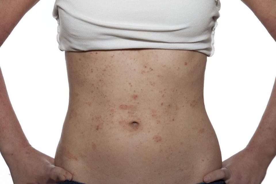 长湿疹怎么一挠一个包,长了湿疹全身痒的不行有什么办法