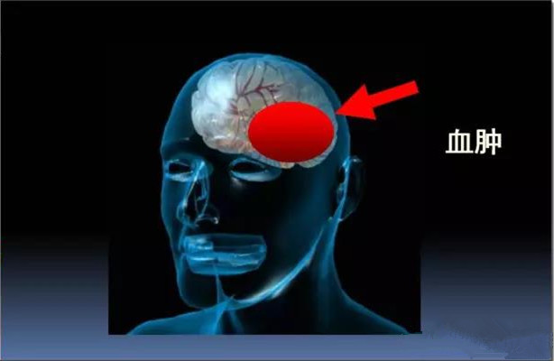 外伤脑积水属于交通性脑积水,正常颅压脑积水概述