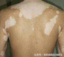 还在担心身上大面积的白癜风不可以治好吗，看完文章就知道了