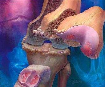 骨关节炎最新诊疗指南,骨关节前十医院