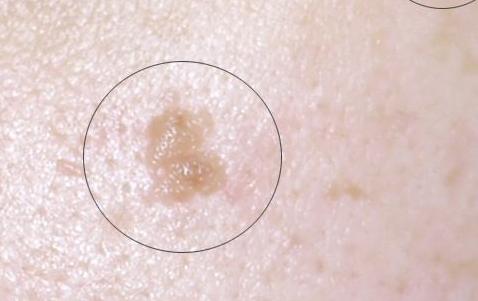 脸上长hpv扁平疣怎么预防,扁平疣怎样预防传染给别人