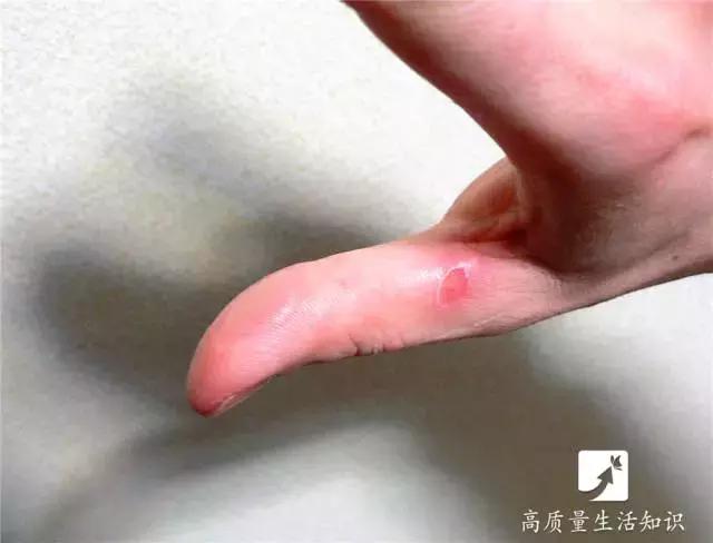 被开水烫伤紧急处理方法,不慎被开水烫伤急救方法