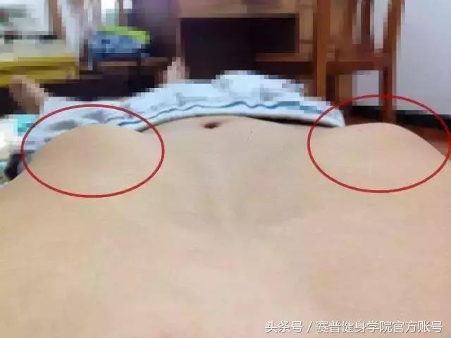 肋骨外翻穿塑身衣可以矫正吗,什么是肋骨外翻怎么矫正