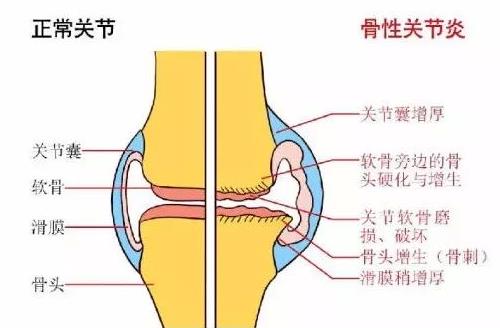 骨关节炎最新诊疗指南,骨关节前十医院