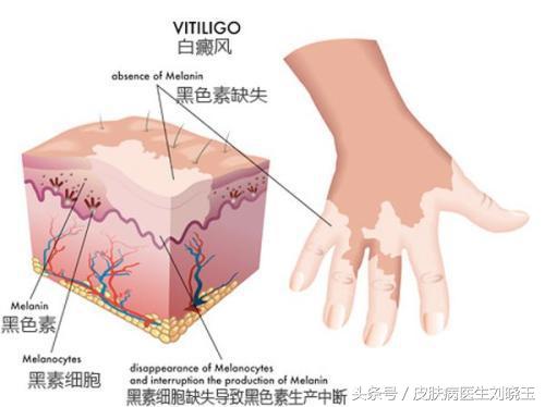 还在担心身上大面积的白癜风不可以治好吗，看完文章就知道了