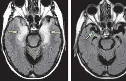 中医治脑炎后遗症最好的方法,脑炎后遗症最好的康复医院