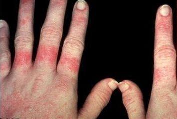 红斑狼疮早期怎么养生,红斑狼疮发现得早可以治好么