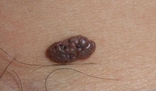 小孩身上长黑色痣越来越多,身上长黑色痣最近发痒怎么回事