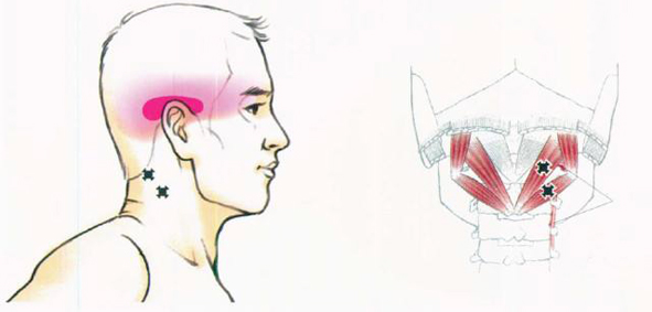 中医治疗鼻子肉疼,中药粉塞鼻治面瘫绝招