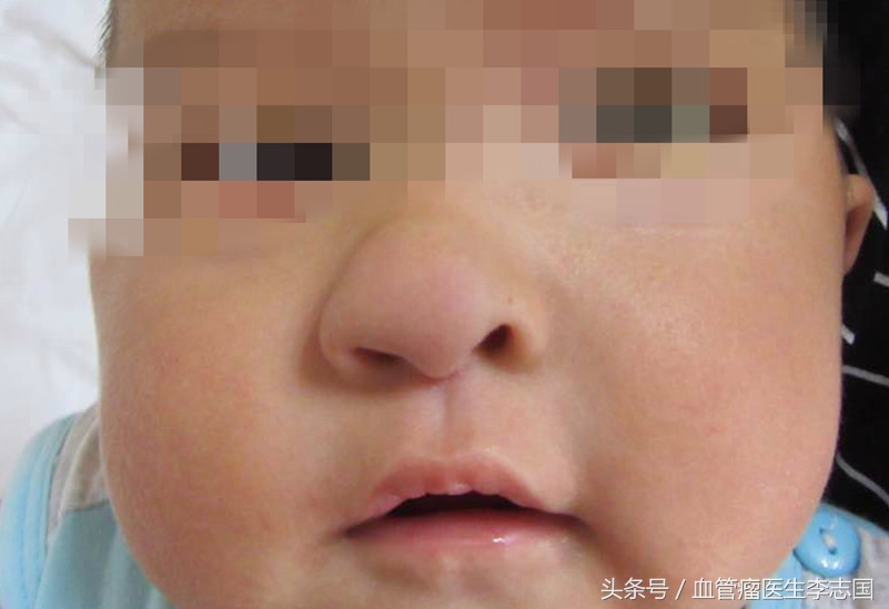男童鼻子先天性堵塞,小孩鼻子恶性肿瘤