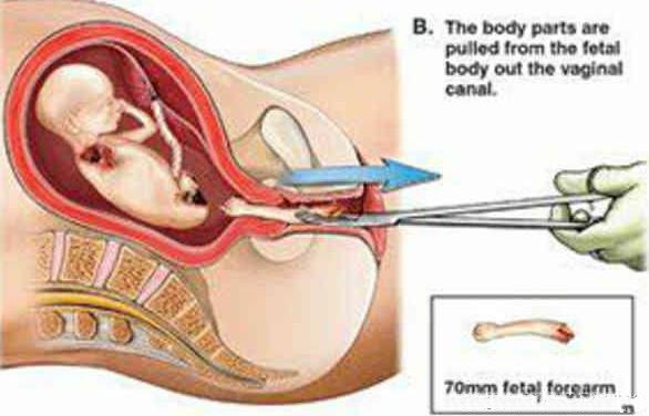 去医院流产之后要经历哪些步骤,孕70天流产哪种流产方式最好