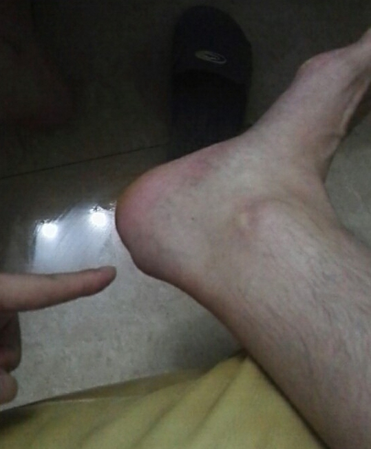 网球肘的最佳打法,三招搞定网球肘