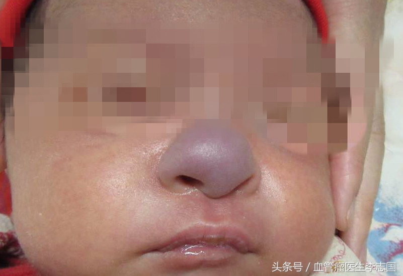 男童鼻子先天性堵塞,小孩鼻子恶性肿瘤