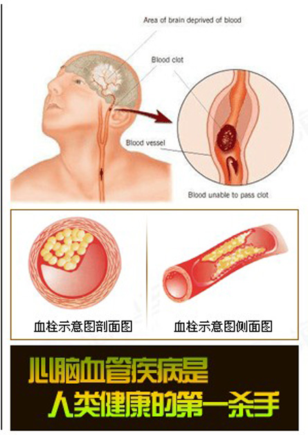 脑供血不足几种病因,椎管狭窄脑供血不足病因