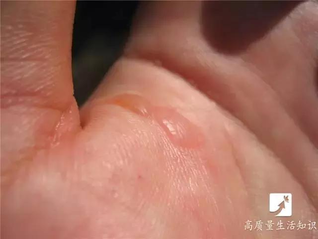 被开水烫伤紧急处理方法,不慎被开水烫伤急救方法