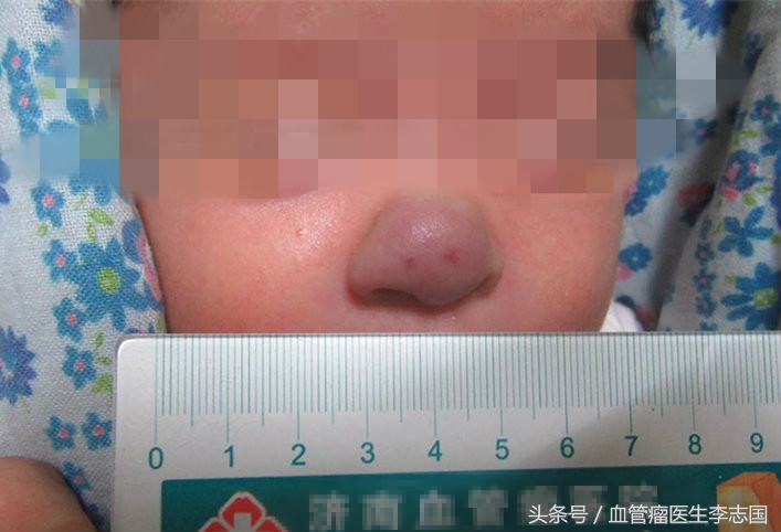 男童鼻子先天性堵塞,小孩鼻子恶性肿瘤