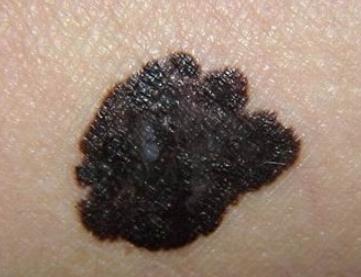 小孩身上长黑色痣越来越多,身上长黑色痣最近发痒怎么回事