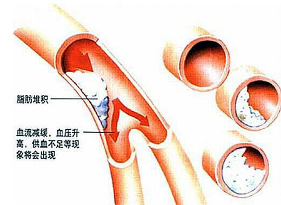 脑供血不足几种病因,椎管狭窄脑供血不足病因