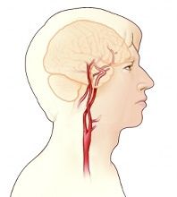 脑供血不足几种病因,椎管狭窄脑供血不足病因