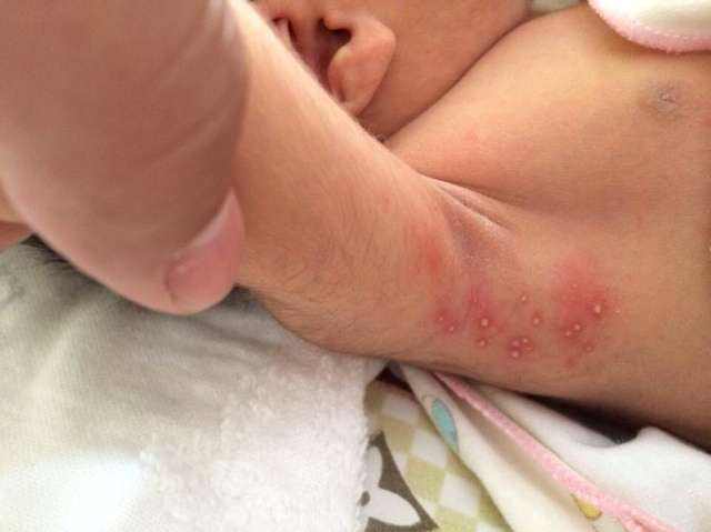 小月龄宝宝湿疹和热疹区别,宝宝粟粒疹和湿疹区别