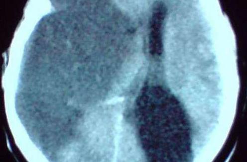 中风后遗症的治疗原则,针灸治疗脑梗塞后遗症效果好吗