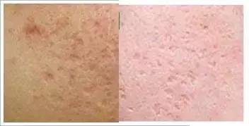 痘痘闭口摸起来软软的,痘痘摸上去硬硬反反复复