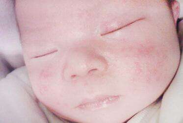 小月龄宝宝湿疹和热疹区别,宝宝粟粒疹和湿疹区别