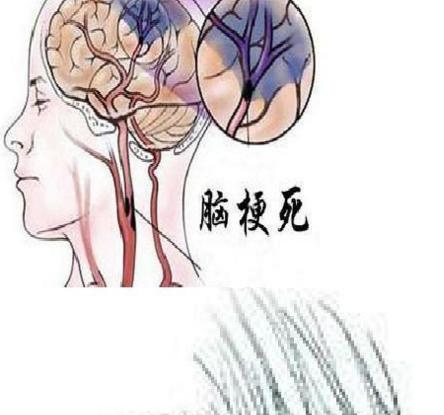 中风后遗症的治疗原则,针灸治疗脑梗塞后遗症效果好吗