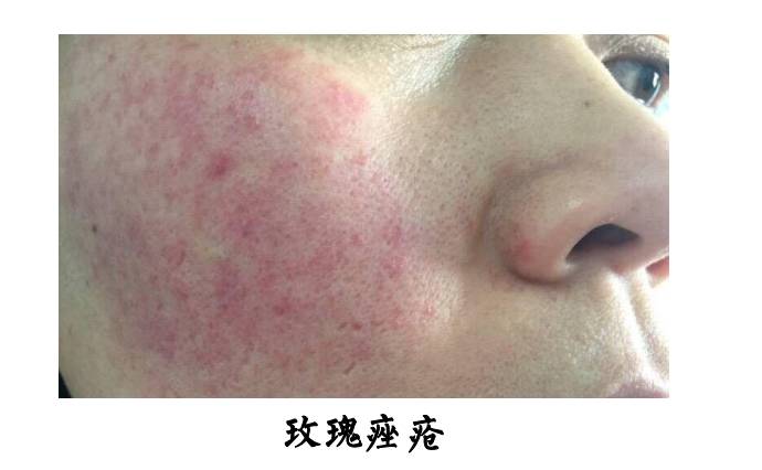 脂溢性皮炎和玫瑰痤疮会并发吗,脂溢性皮炎和玫瑰痤疮的区别