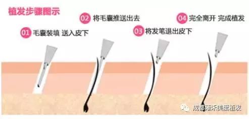 想要治疗遗传性脱发，原来还是要从这点入手……