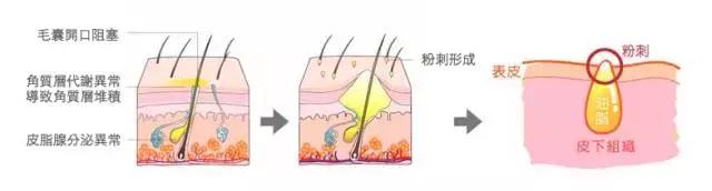 痘痘闭口摸起来软软的,痘痘摸上去硬硬反反复复