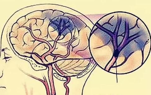 脑梗塞后遗症肢体康复训练,周口脑梗塞后遗症康复医院哪个好